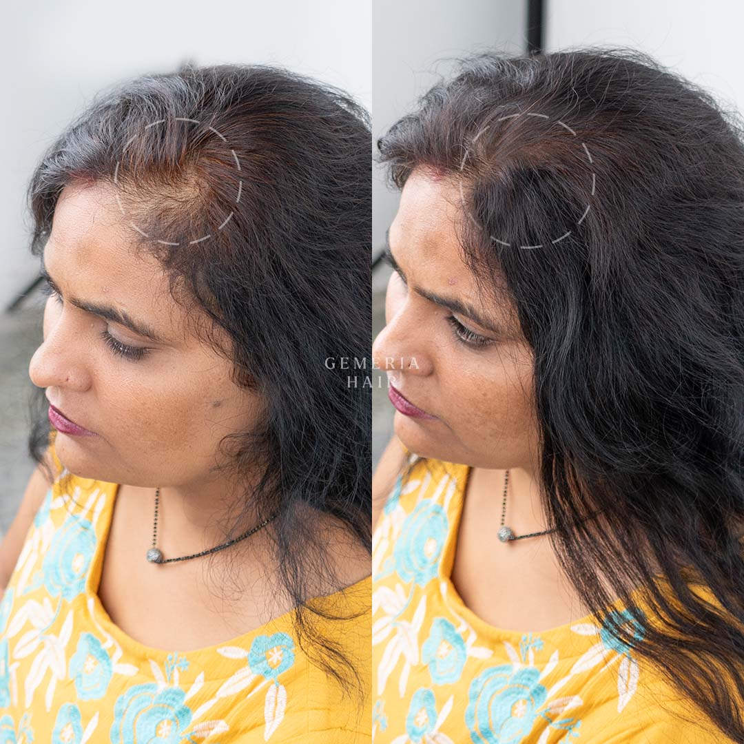 Before and after using hair patch